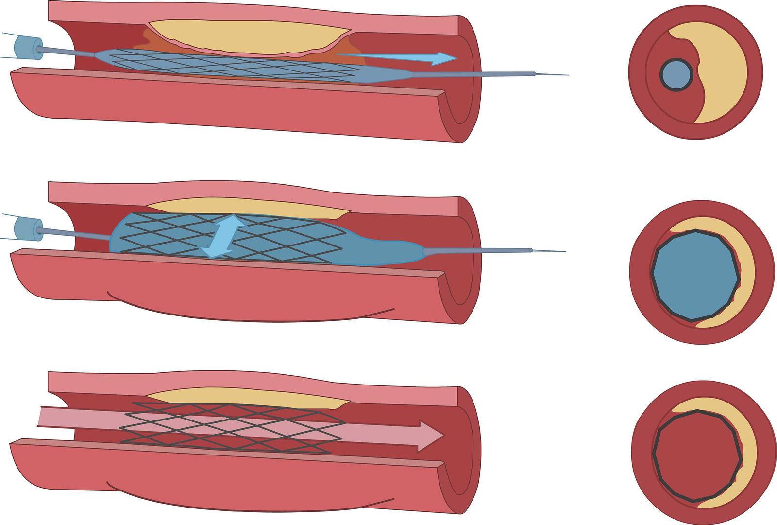 Endovasculaire angioplastiek en stent Voorbeeldafbeelding - Tulsa Cardiovascular